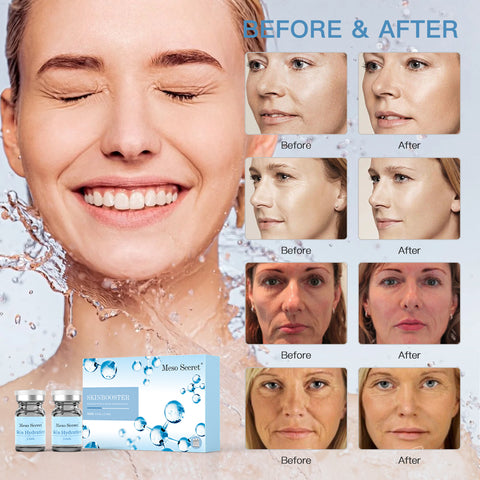 Skinbooster Meso Secret Injectable Hyaluronic Acid
