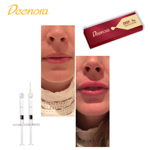 Hyaluronic Acid Filler 1ml 2ml 10ml Crosslinked HA Dermal Filler Nose Lip Breast